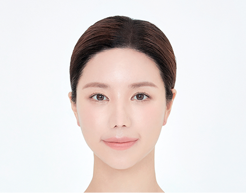 Non-incision hair transplant after