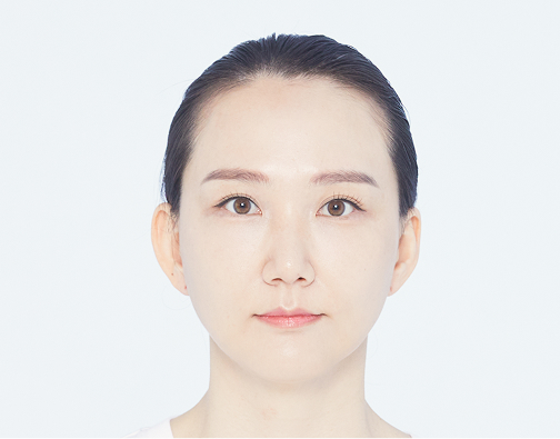 Non-incision hair transplant before