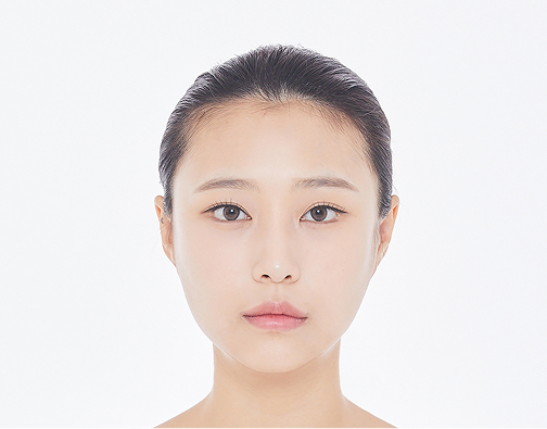Non-incision hair transplant before