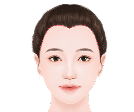 M-shaped forehead