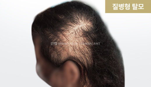 질병형 탈모
