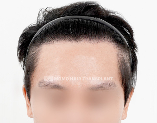 Forehead lift scar cover incisional hair transplant after