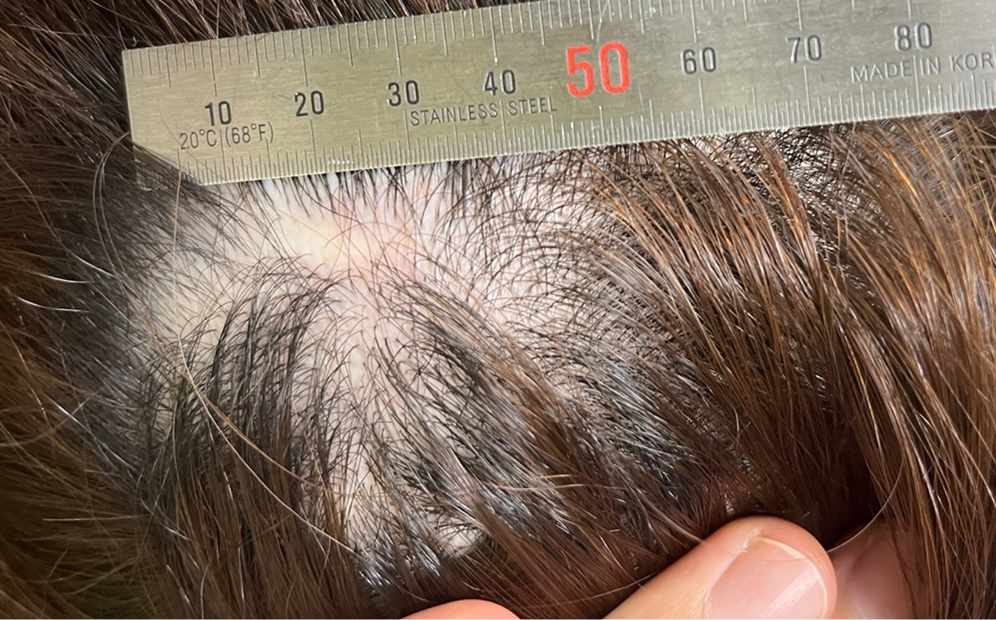 Scalp incision scar after contouring surgery