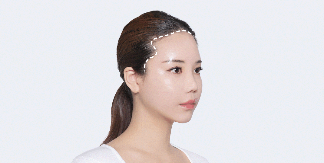 모모 흉터커버 모발이식이 특별한 이유